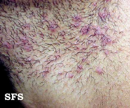 Download Ingrown Hair In Groin Area Gif