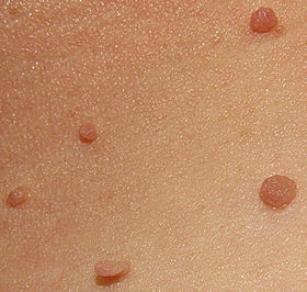 Skin tags