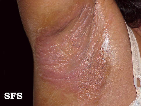 Underarm rash - contact dermatitis