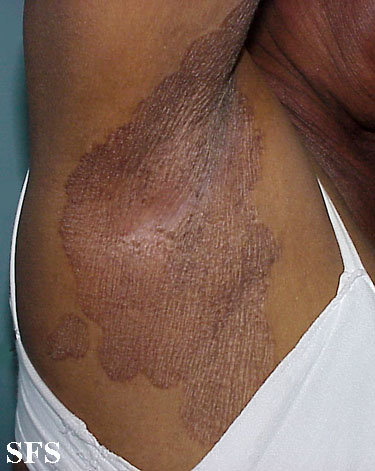 Armpit Rash (Red, Dark, Itchy, Painful Bumps): Causes 