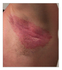Armpit Rash (Red, Dark, Itchy, Painful Bumps): Causes