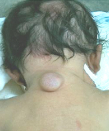 Cervical meningocele - a lump at the back of the neck
