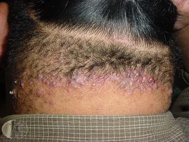 Folliculitis keloidalis - red bumps at the nape of the neck