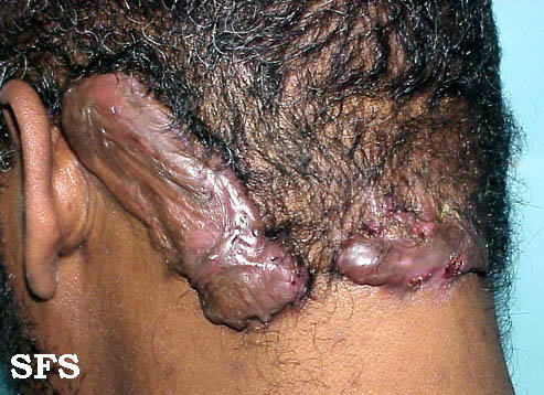 Keloid at the back of the head