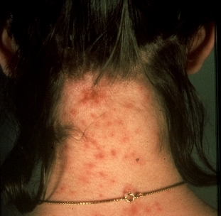 Lice bites - red bumps on neck