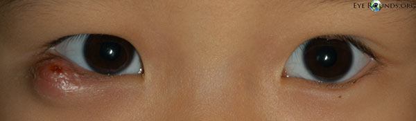 Chalazion - lower eyelid