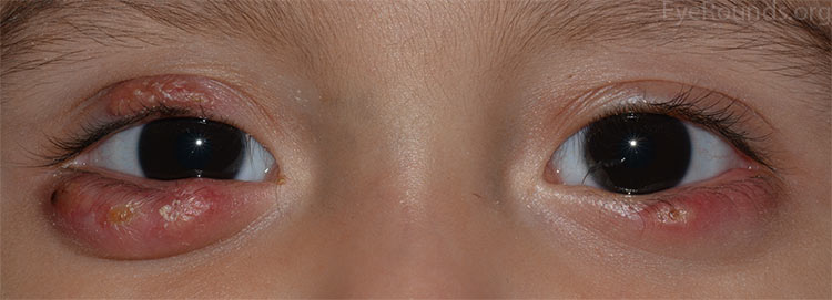 Chalazion in eyelids