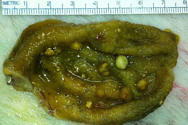 Gallbladder polyps