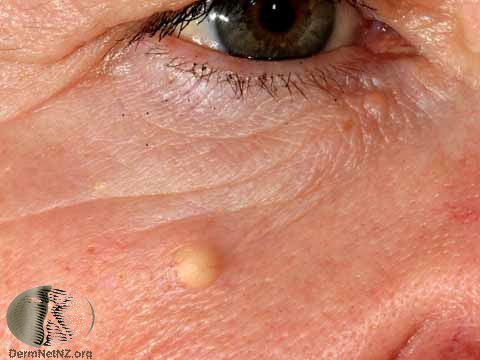 An epidermoid cyst on the face