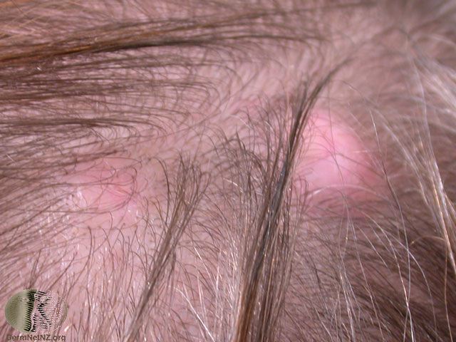 Sebaceous cyst (pilar cyst) on the scalp