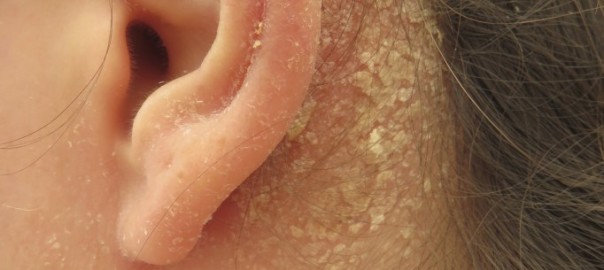 Seborrheic dermatitis behind the ear