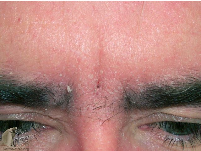 Seborrheic dermatitis in the eyebrows
