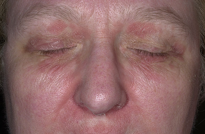 Facial seborrheic dermatitis