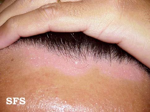 Seborrheic dermatitis on the hairline