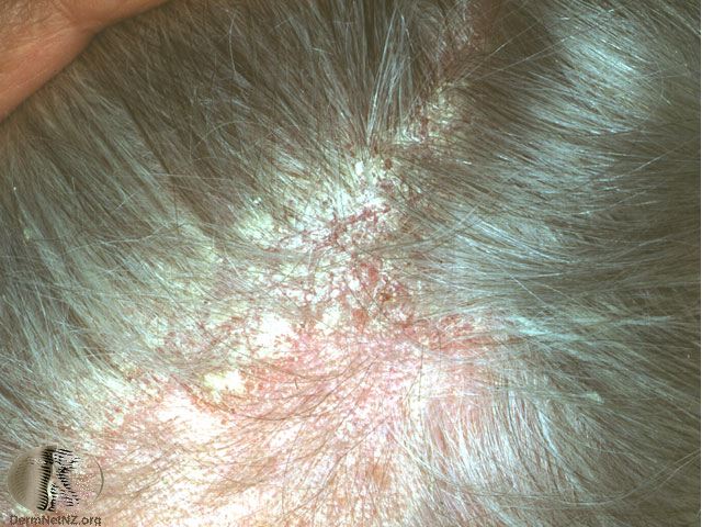 Seborrheic dermatitis on the scalp