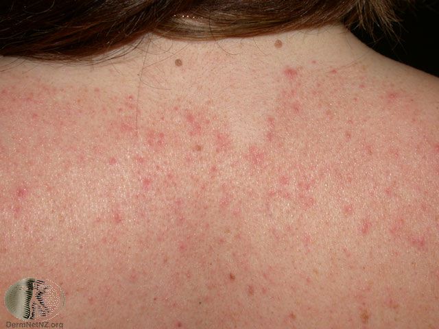 Seborrheic dermatitis on the upper back