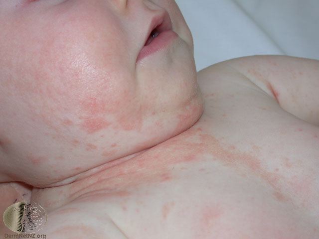 Severe seborrheic dermatitis in an infant
