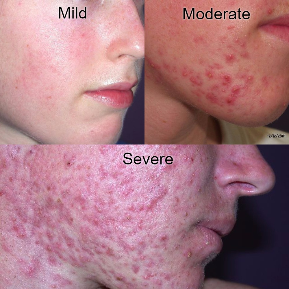 Moderate Acne Face