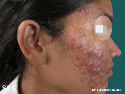 Cystic acne on the face
