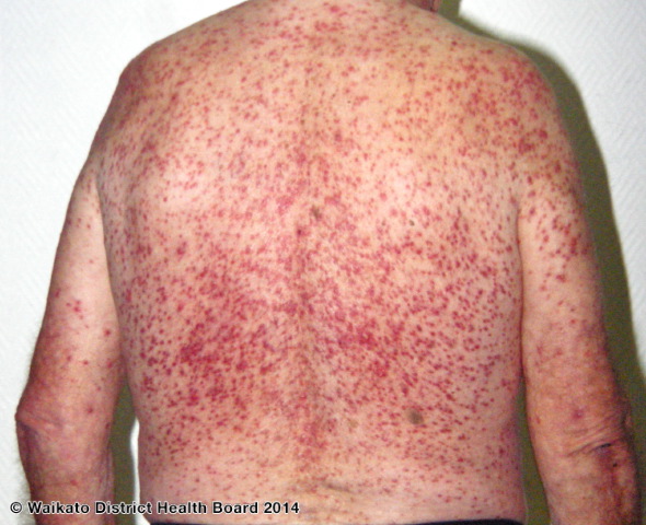 Severe hormonal acne on the back