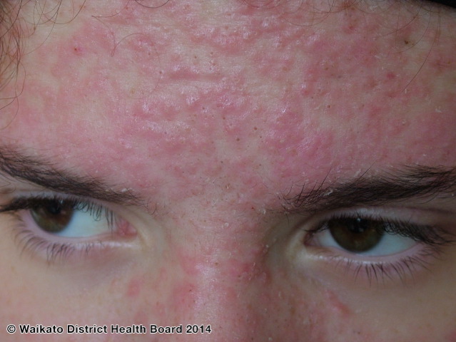 Hormonal steroid acne on the forehead