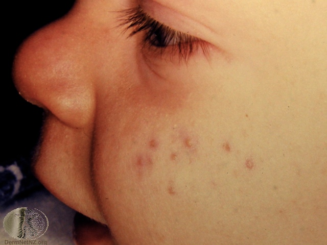 Mild infantile acne