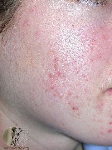 Moderate acne - papules