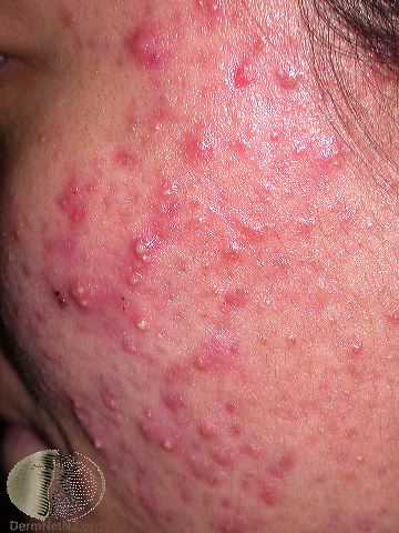 Moderate acne - pustules