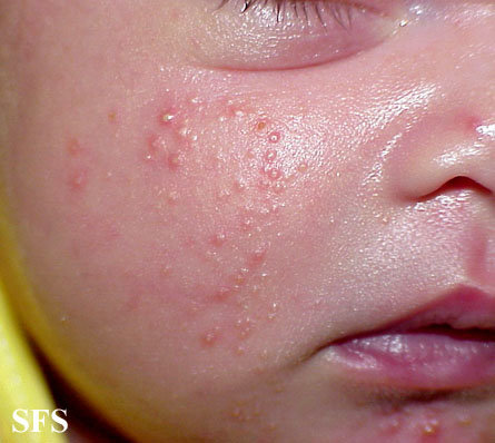 Neonatal acne (in a newborn)