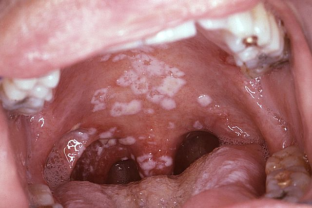 Oral thrush in HIV/AIDS