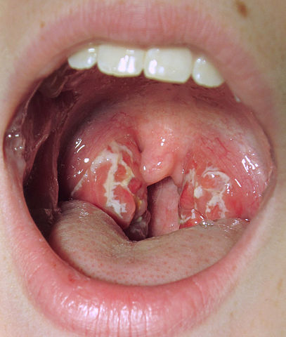 Strep throat - bacterial tonsillitis