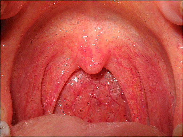 Inflamed red throat in viral pharyngitis