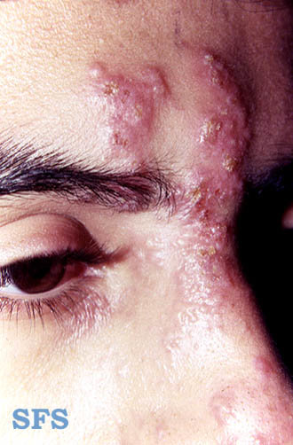 Shingles on the forehead and nose