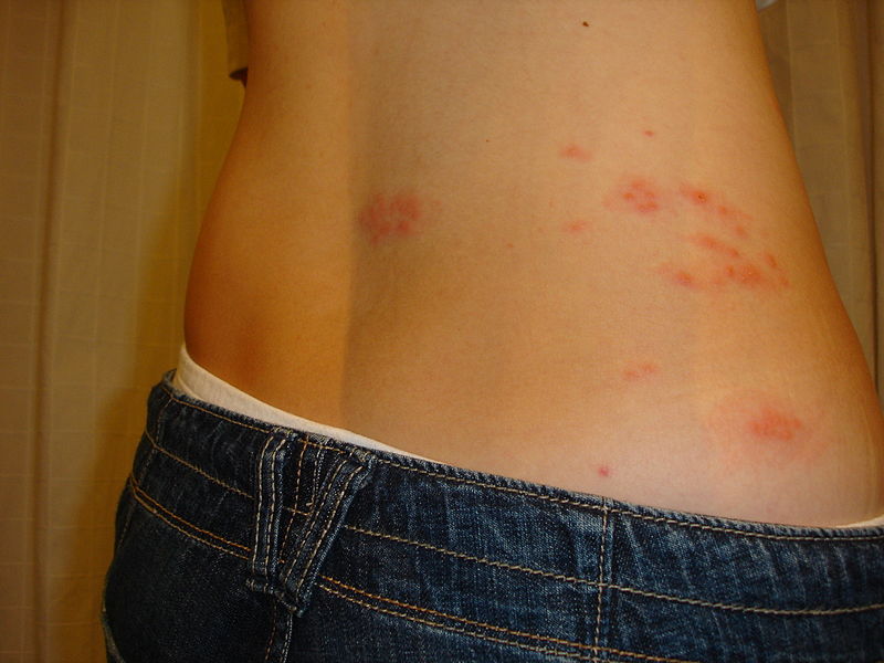 Mild shingles rash on the lower back