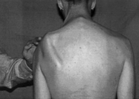 Lateral scapular winging