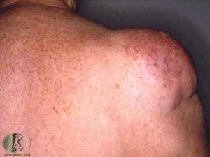 A lipoma on the shoulder