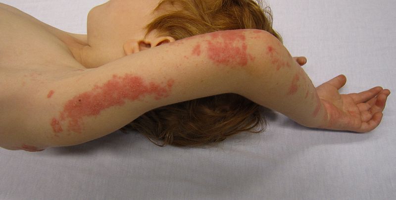 Shingles rash on the arm in a child