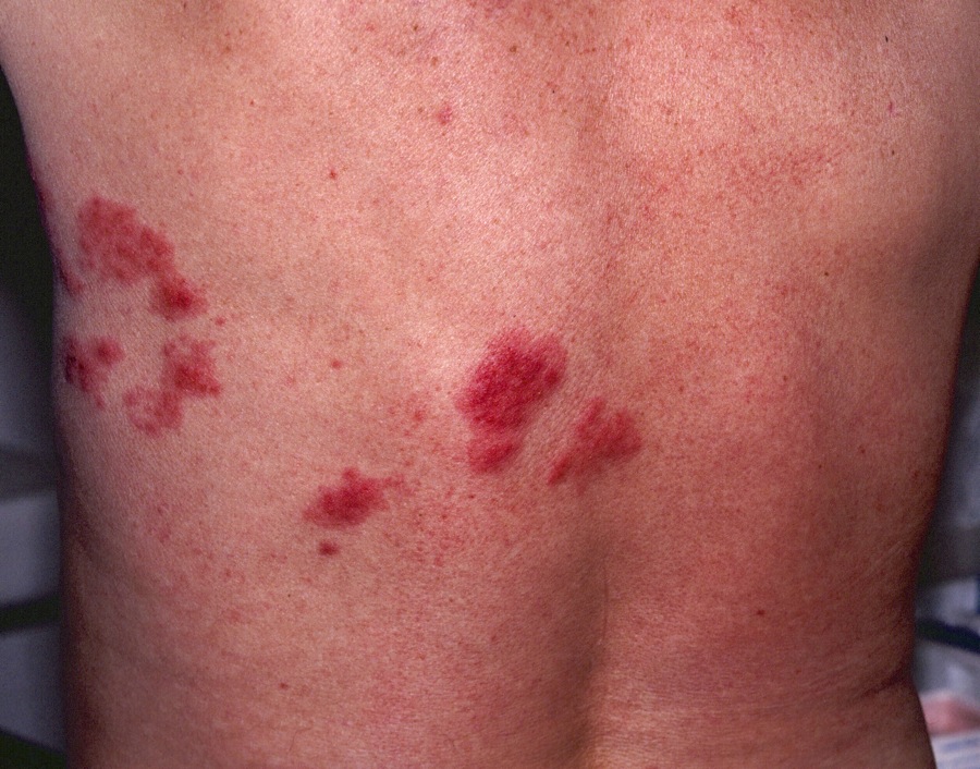 Early Stage Shingles Rash Libracha